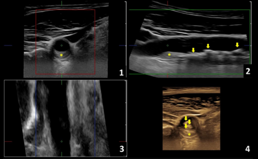 ECOGRAFÍA 3D DE LA ARTERIA CARÓTIDA 